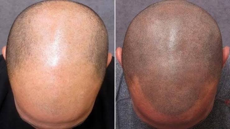 Hanafy X D-Chris DOTX Scalp set